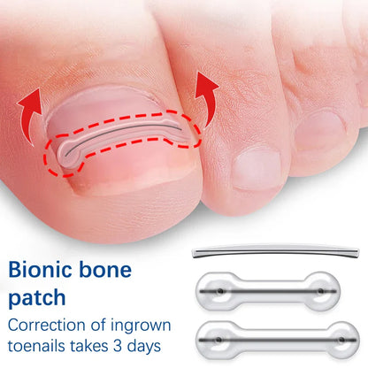 2-Piece Ingrown Toenail Correction Kit – Elastic Patch & Straightening Clip Pedicure Tool for Toe Nail Treatment