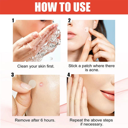 144PCS Acne Pimple Patch Set – Invisible Hydrocolloid Spot Stickers for Face Care & Healing (Men & Women)