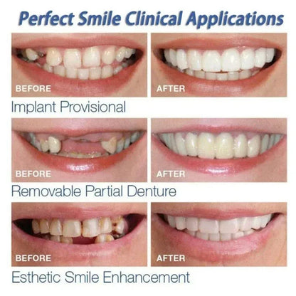 Silicone Denture Set — Temporary Orthodontic Teeth, Fake Tooth Braces for Oral Hygiene, Whitening & Dental Simulation