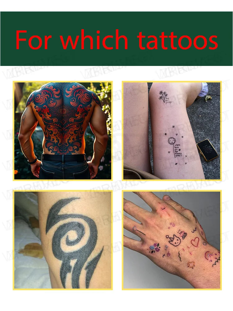 Laser Tattoo Removal Pen – Effective Portable Tattoo Eraser