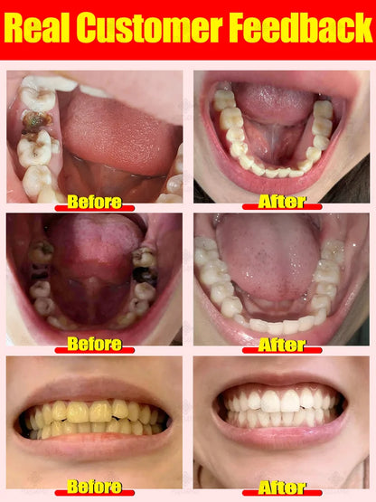 Rapid Cavity Repair Toothpaste – Effective Tooth Decay Treatment