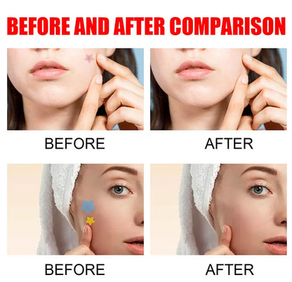 Acne Repair Patch - Facial Skin Care for Blemish & Pimple Marks, Acne Treatment & Pimple Repair Cover
