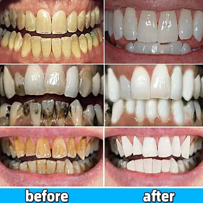 Dental Calculus Remover Toothpaste – Whitening, Bad Breath Removal & Periodontitis Prevention for Teeth Car