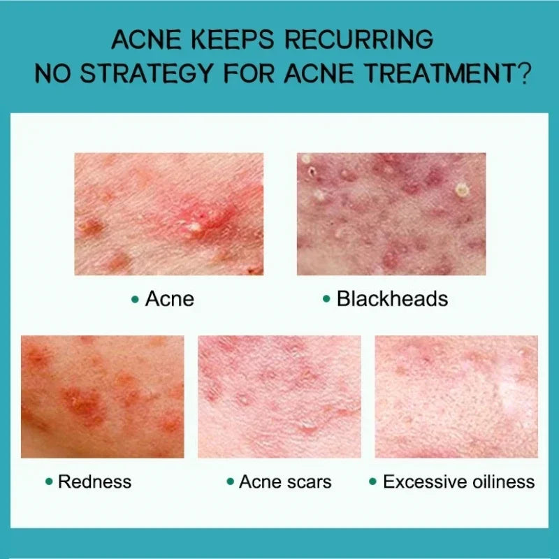 Salicylic Acid Acne Removal Cream – Anti-Acne, Redness Repair, Deep Cleaning & Oil Control Skincare