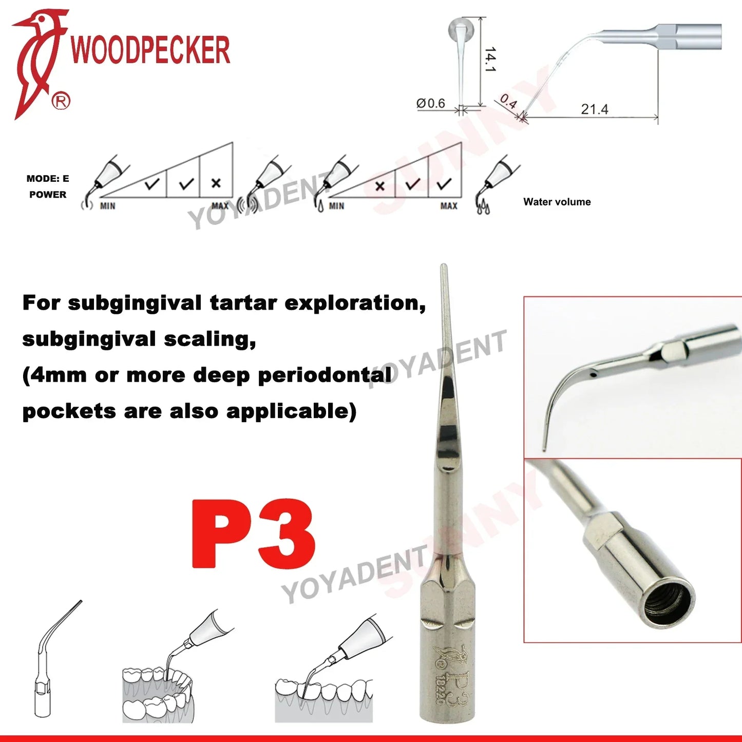 Woodpecker Dental Scaler Tips – Ultrasonic Tooth Cleaning, Endo & Perio Scaling Tips, Fit EMS UDS Scaler Handpiece