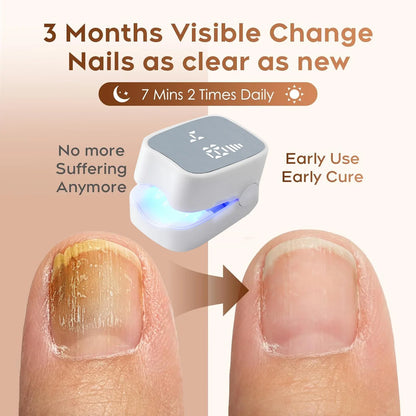 Rechargeable Laser Nail Fungus Remover Device – Effective Treatment for Damaged, Discolored & Thick Fingernails Repair