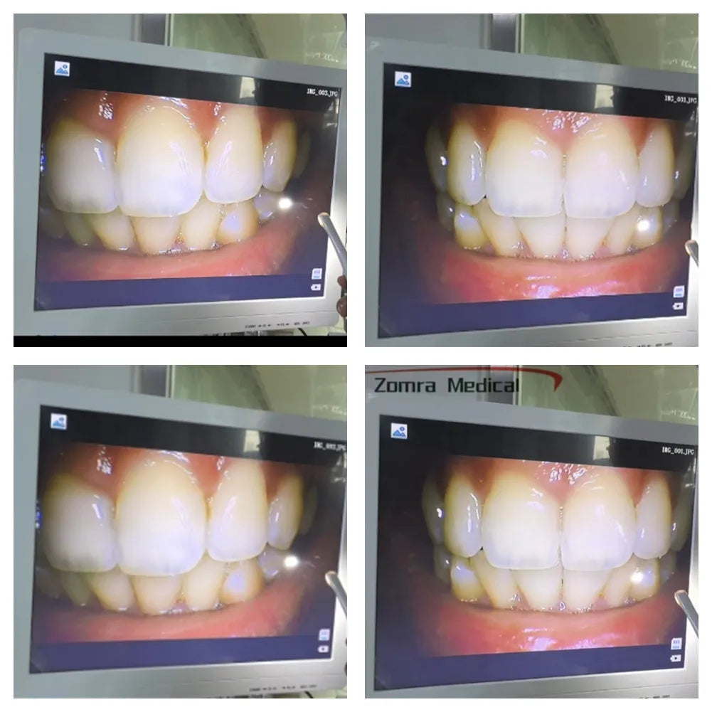 Portable Dental Intraoral Camera – High-Resolution Oral Examination with AV/TV Connection