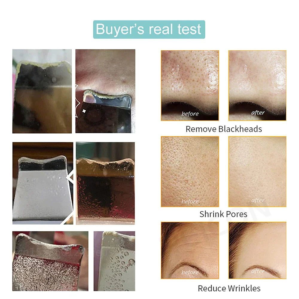 Ultrasonic Skin Scrubber: Blackhead Remover & Deep Face Cleaning Ion Acne Pore Cleaner - Facial Shovel Cleanser