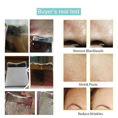 Ultrasonic Skin Scrubber: Blackhead Remover & Deep Face Cleaning Ion Acne Pore Cleaner - Facial Shovel Cleanser