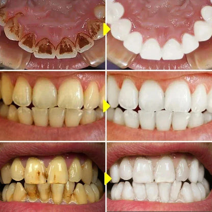 Teeth Whitening Toothpaste – Fruit Acid Formula for Plaque Removal, Stain & Calculus Cleanser, Fresh Breath & Oral Hygiene