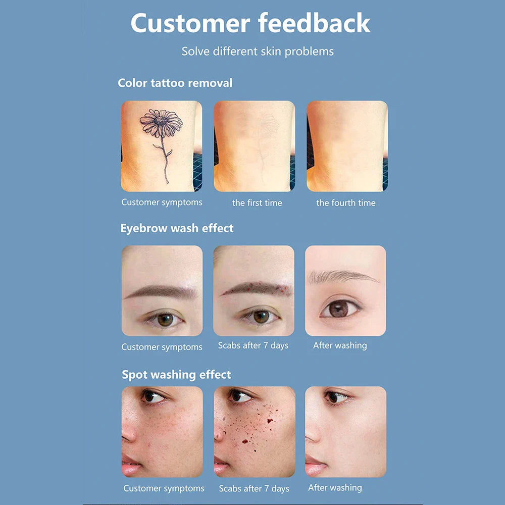 Q-Switch ND YAG Laser Machine – Tattoo & Eyebrow Removal, Mole & Freckle Whitening (532nm 755nm 1064nm)