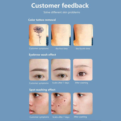 Q-Switch ND YAG Laser Machine – Tattoo & Eyebrow Removal, Mole & Freckle Whitening (532nm 755nm 1064nm)