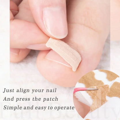 Ingrown Nail Correction Stickers - 40/100/200pcs Toenail Corrector Patches for Paronychia Treatment and Pedicure Recovery
