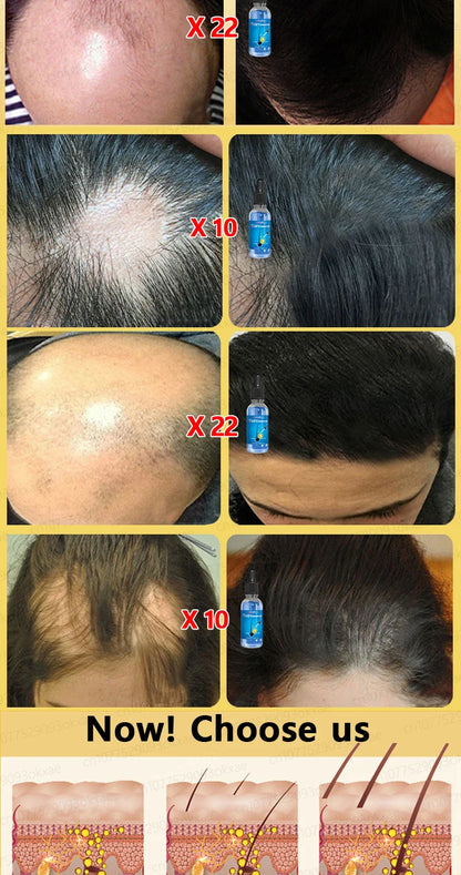 WPRBREGT Blue Hair Growth Serum — Essential Oil for Thicker Hair, Anti-Baldness Treatment