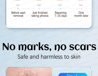 Safe Skin-Friendly Wart Removal Methods – Gentle Solutions for Effective Wart Treatment