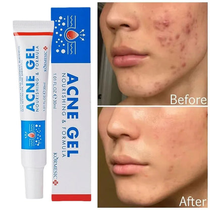 Effective Acne Removal Cream 30g – Anti-Acne Gel for Redness, Pimples, Deep Pore Cleaning & Oil Control Skin Care