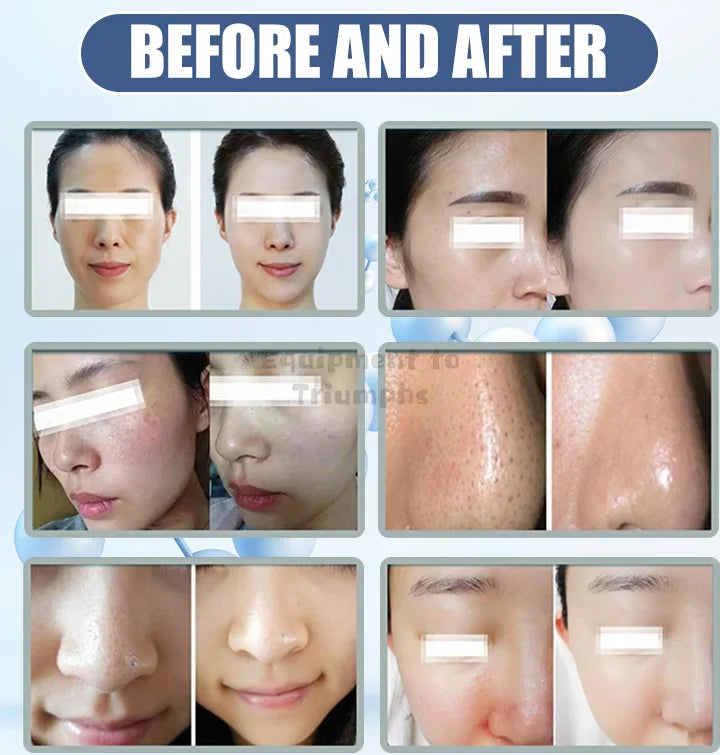2024 Newest Portable 4 Bars Water Injection Gun – Hydro H2O2 Water Jet Facial Machine for Skin Lifting, Beauty Device