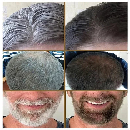 White Hair Remover – Restore Natural Hair Color in 7 Days, Gray Hair Treatment Solution
