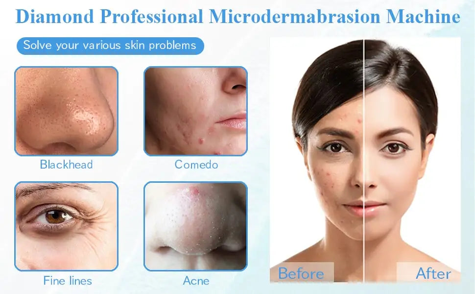 Diamond Microdermabrasion Machine – 65-68cmHg Suction Professional Facial Skin Care Equipment for Home Use