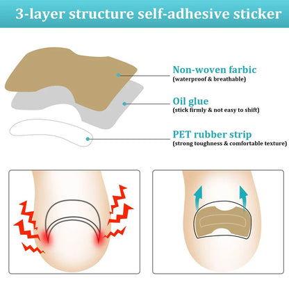 Ingrown Toenail Correction Patch Stickers Set - Pedicure Tool for Toe Nail Treatment and Foot Care