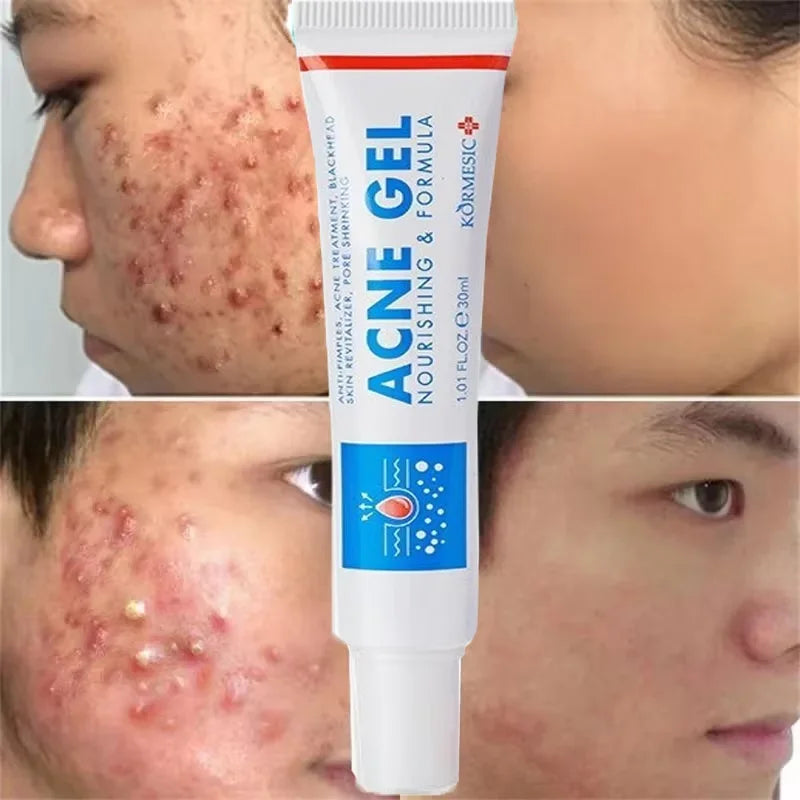 Effective Acne Removal Cream – Anti-Acne Gel for Redness, Pimples, Deep Pore Cleaning & Oil Control Skin Care