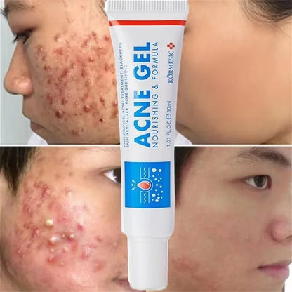 Effective Acne Removal Cream – Anti-Acne Gel for Redness, Pimples, Deep Pore Cleaning & Oil Control Skin Care