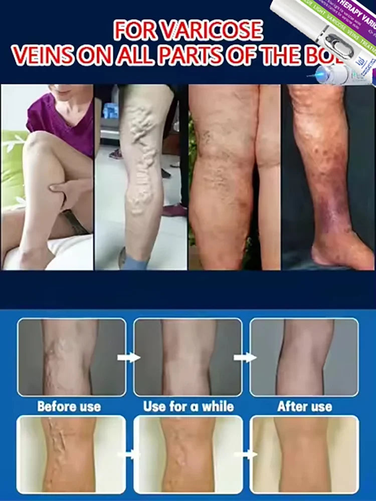 Varicose Vein & Spider Leg Pain Relief Treatment — Painless Care for Vasculitis & Phlebitis
