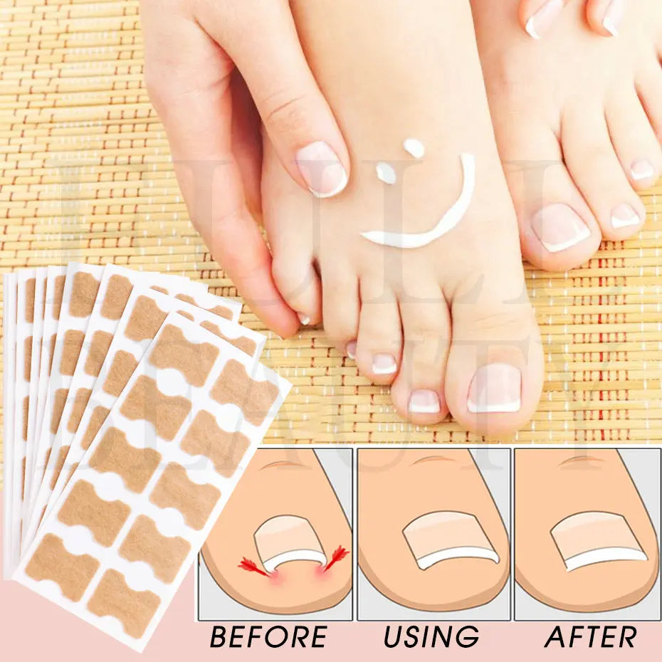 Ingrown Nail Correction Stickers - 40/100/200pcs Toenail Corrector Patches for Paronychia Treatment and Pedicure Recovery