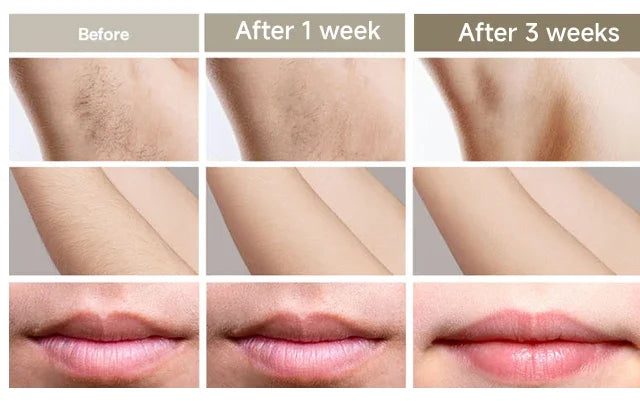 IPL Laser Hair Removal Device – 999,999 Flashes Painless Epilator for Women, Permanent At-Home Bikini & Body Hair Removal