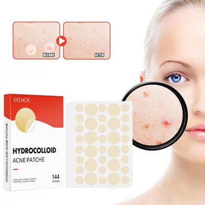 144pcs Face Acne Pimple Patch Set – 2 Sizes Invisible Professional Healing Spot Stickers for Men & Women Skin Care
