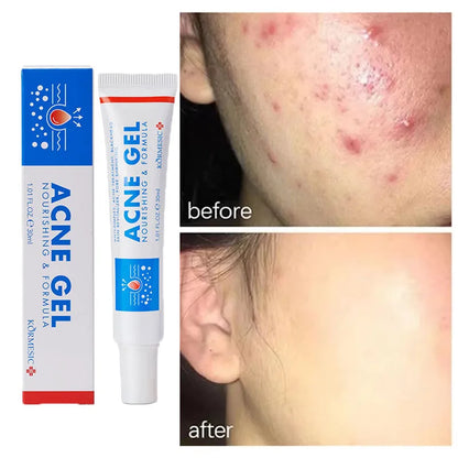 Effective Acne Removal Cream – Anti-Acne Gel for Redness, Pimples, Deep Pore Cleaning & Oil Control Skin Care