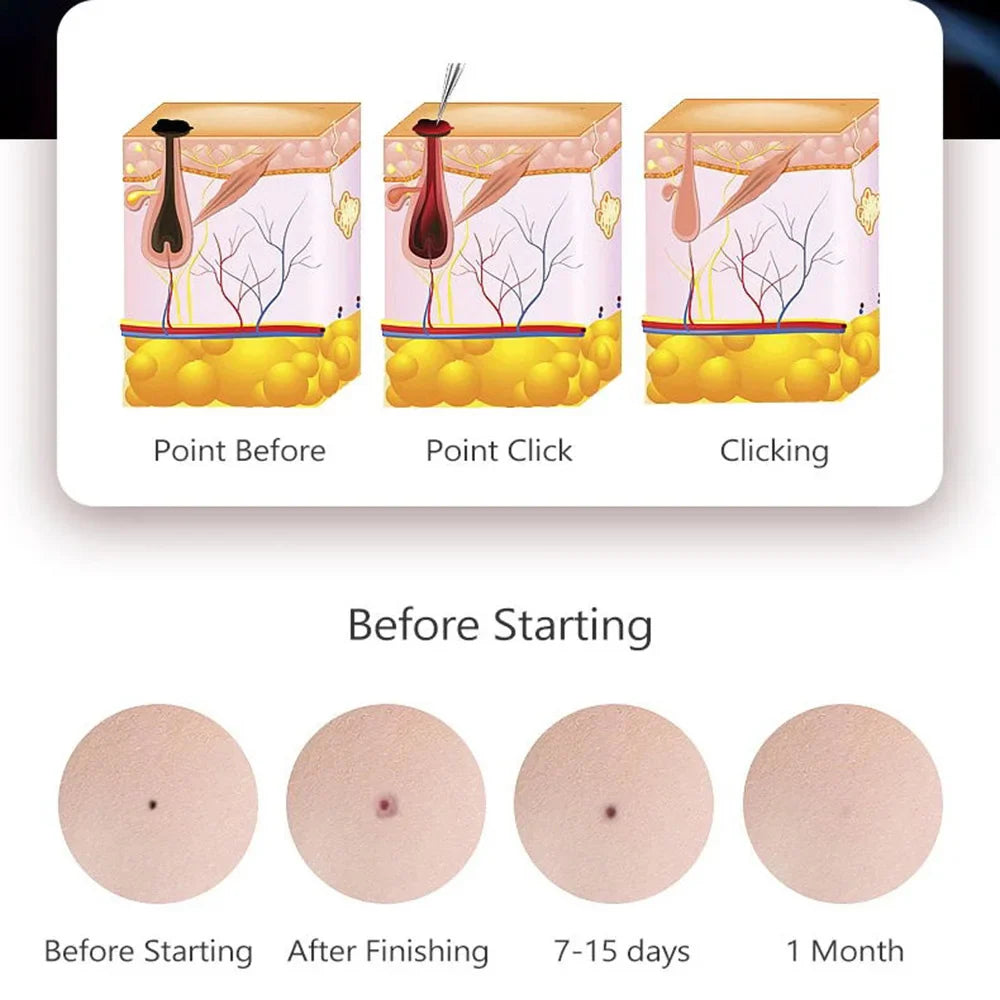 50/100pcs Sterile Surgical Needles for Mini Mole Removal Pen – Spot, Freckle & Plasma Point Beauty Accessories