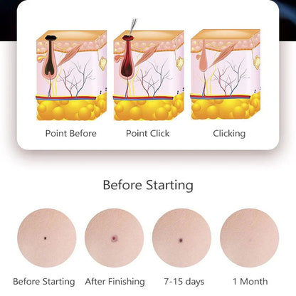 50/100pcs Sterile Surgical Needles for Mini Mole Removal Pen – Spot, Freckle & Plasma Point Beauty Accessories