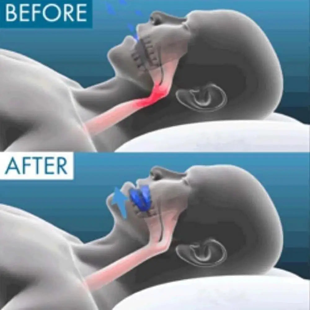 Gum Shield Anti-Snoring Mouthpiece – Snore Stopper Device for Better Breathing & Snoring Relief