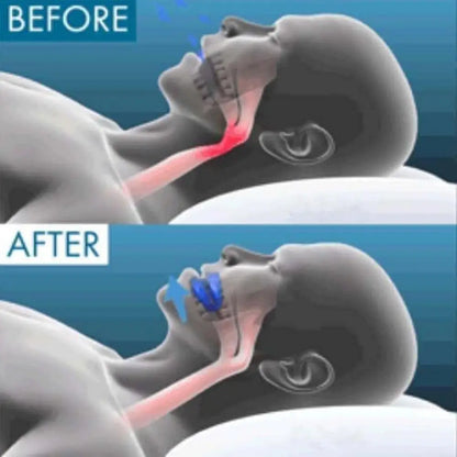 Gum Shield Anti-Snoring Mouthpiece – Snore Stopper Device for Better Breathing & Snoring Relief