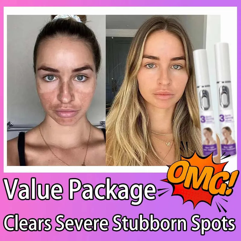 Freckle & Dark Spot Removal Treatment – Fade Chloasma, Age Spots, Acne Marks & Sun Spots