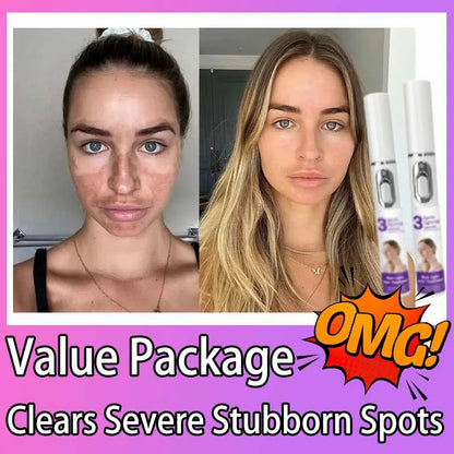 Freckle & Dark Spot Removal Treatment – Fade Chloasma, Age Spots, Acne Marks & Sun Spots