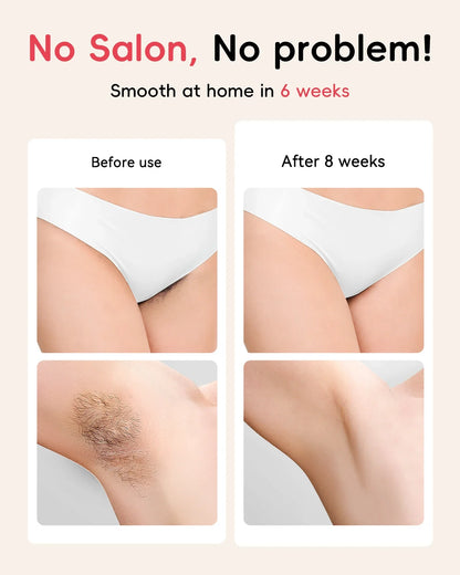 IPL Hair Removal Laser 22J — Unlimited Flashes IGBT, 5.2cm² Light Painless Epilator for Face, Armpit & Bikini Body Treatment