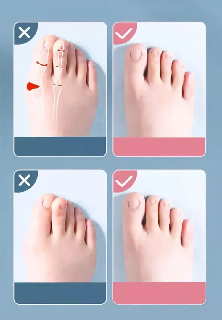 2Pc Silicone Toe Separator — Foot & Toe Spreader for Hallux Valgus, Bunion Correction & Toe Straightening
