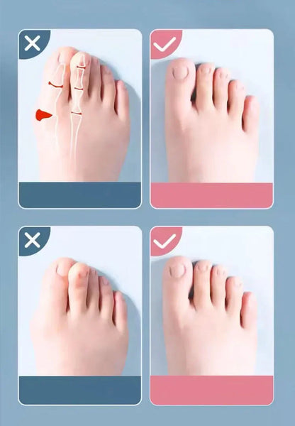 2Pc Silicone Toe Separator — Foot & Toe Spreader for Hallux Valgus, Bunion Correction & Toe Straightening