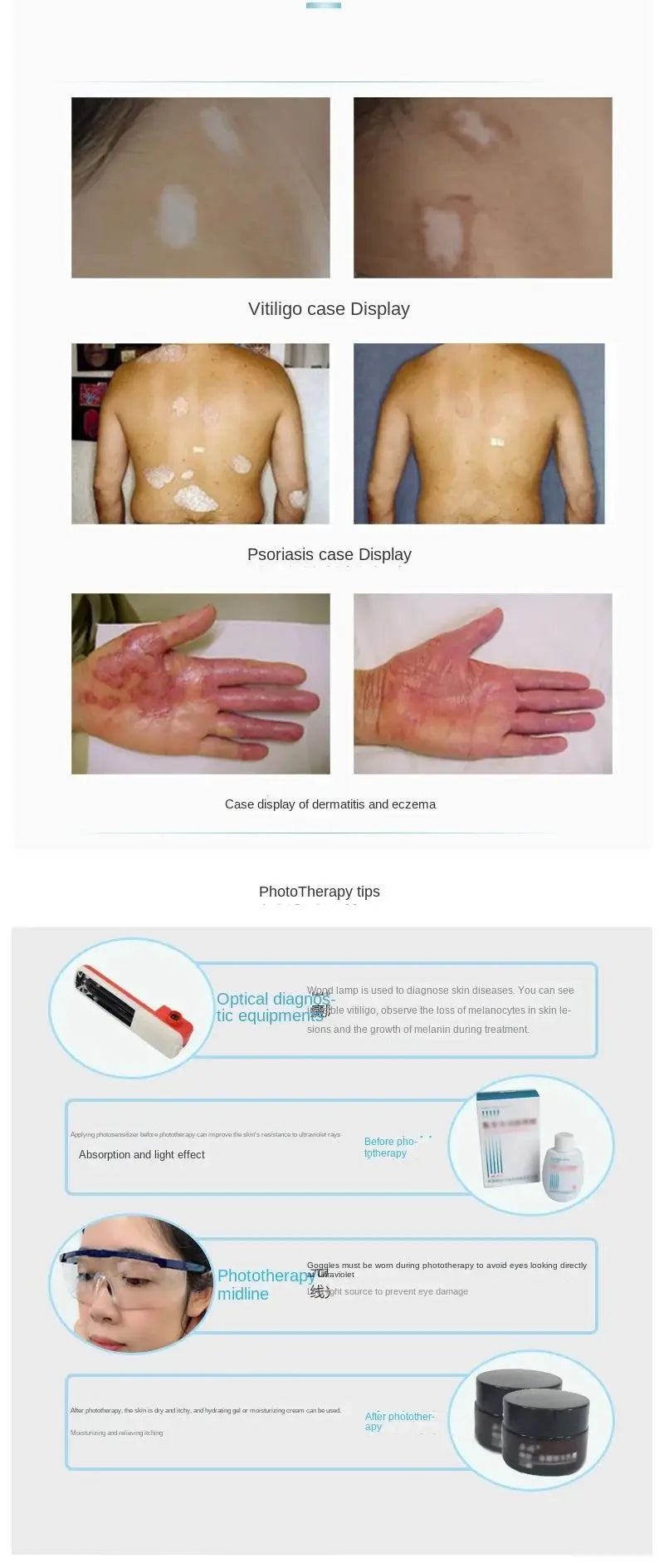 UV 311nm Phototherapy Device – Philips UVB Lamp for Vitiligo, Psoriasis & Skin Treatment