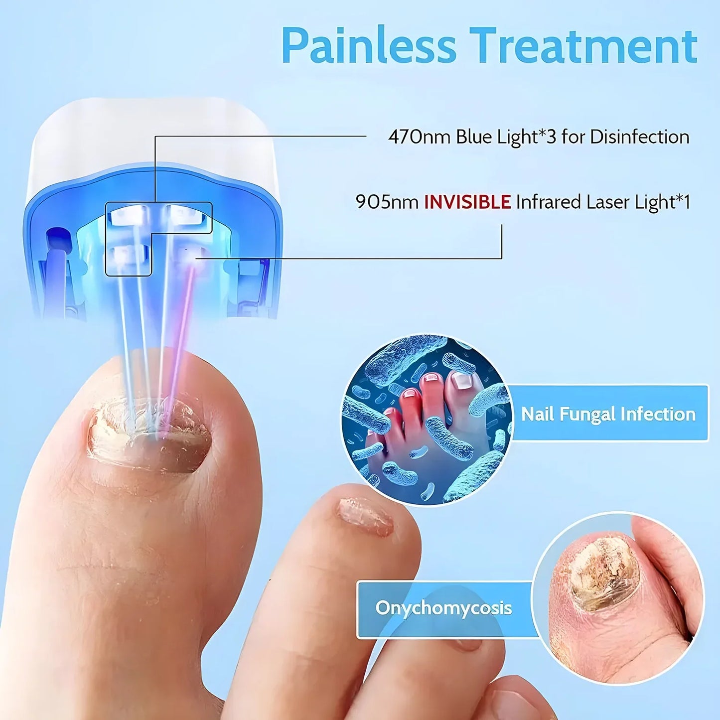 Rechargeable Laser Nail Fungus Remover Device – Effective Treatment for Damaged, Discolored & Thick Fingernails Repair