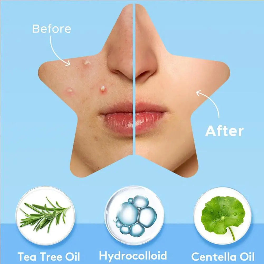 Colorful Star Pimple Patches – Invisible Acne Spot Stickers for Skin Care, Concealer & Makeup Tools