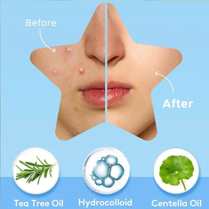 Colorful Star Pimple Patches – Invisible Acne Spot Stickers for Skin Care, Concealer & Makeup Tools