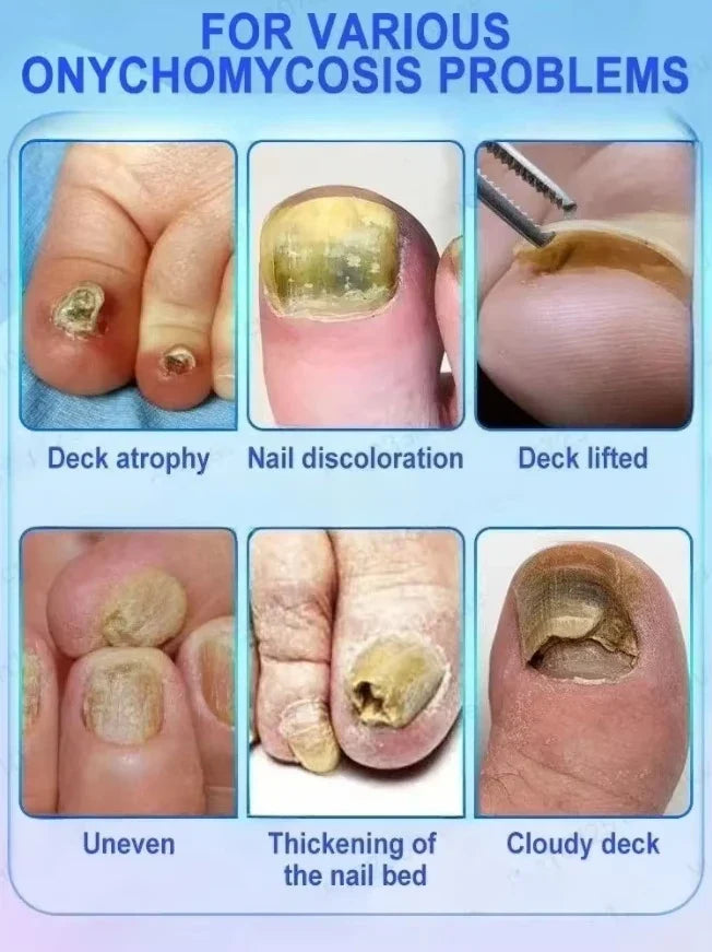 Fast Nail Fungus Treatment Solution – Restore Healthy Looking Nails Quickly & Effectively
