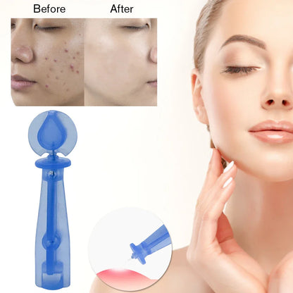 50/100PCS Blackhead Remover Acne Needle Tool - Disposable Skin Care Tools for Acne & Fat Grain Removal