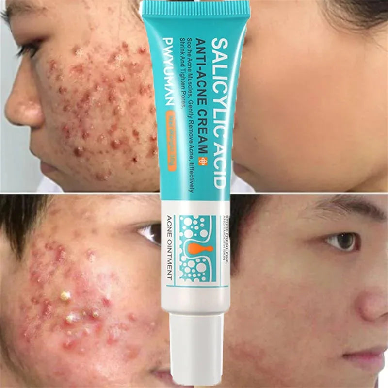 Salicylic Acid Acne Removal Cream – Anti-Acne, Redness Repair, Deep Cleaning & Oil Control Skincare