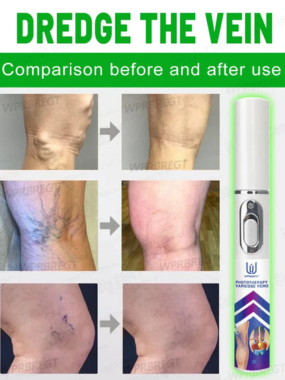 2nd Gen Varicose Vein Laser Therapy Device – Relieves Spider Leg Pain, Treats Vasculitis & Phlebitis