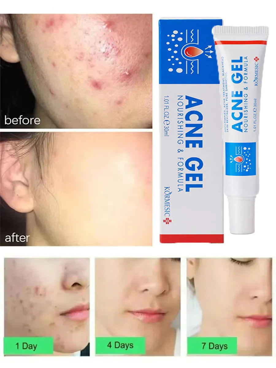 Effective Acne Removal Cream – Anti-Acne Gel for Redness, Pimples, Deep Pore Cleaning & Oil Control Skin Care