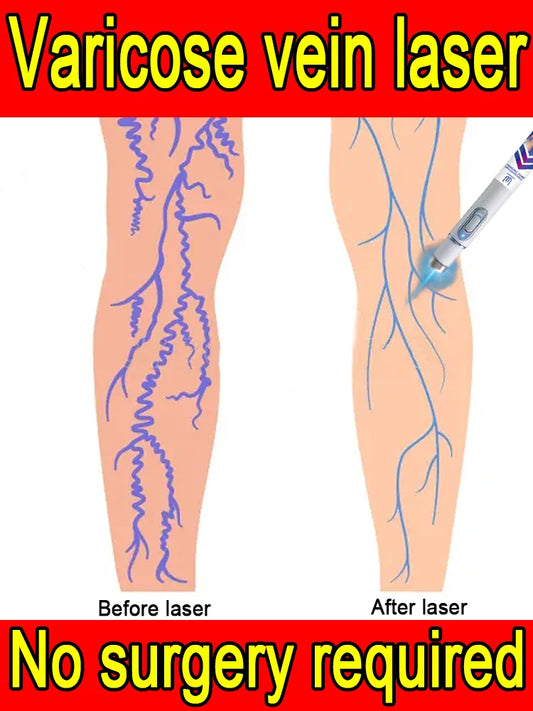 2nd Gen Varicose Vein Laser Therapy Device – Relieves Spider Leg Pain, Treats Vasculitis & Phlebitis